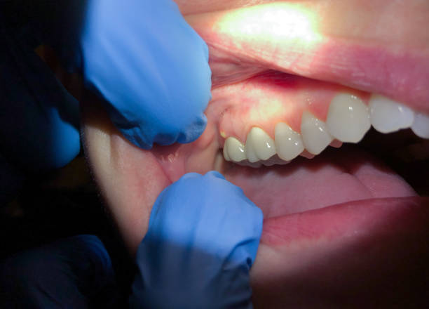 Best Emergency Treatment for Oral Infections in East Bernard, TX